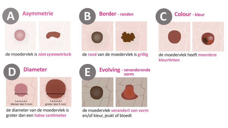 Check je moedervlek met de ABCDE-methode