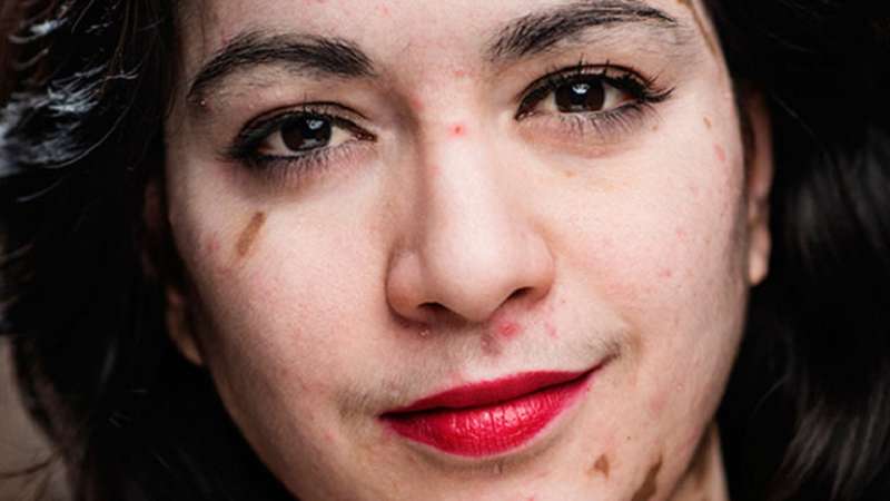 Ervaring met vitiligo - het verhaal van Sharita