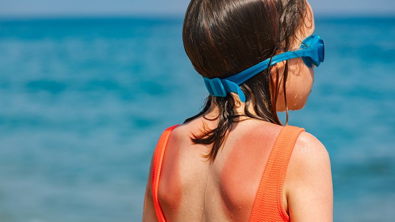 Zonmonitor 2024: 76% van de kinderen afgelopen zomer verbrand