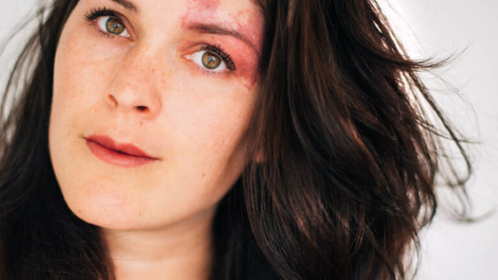 Mariët heeft een wijnvlek in haar gezicht