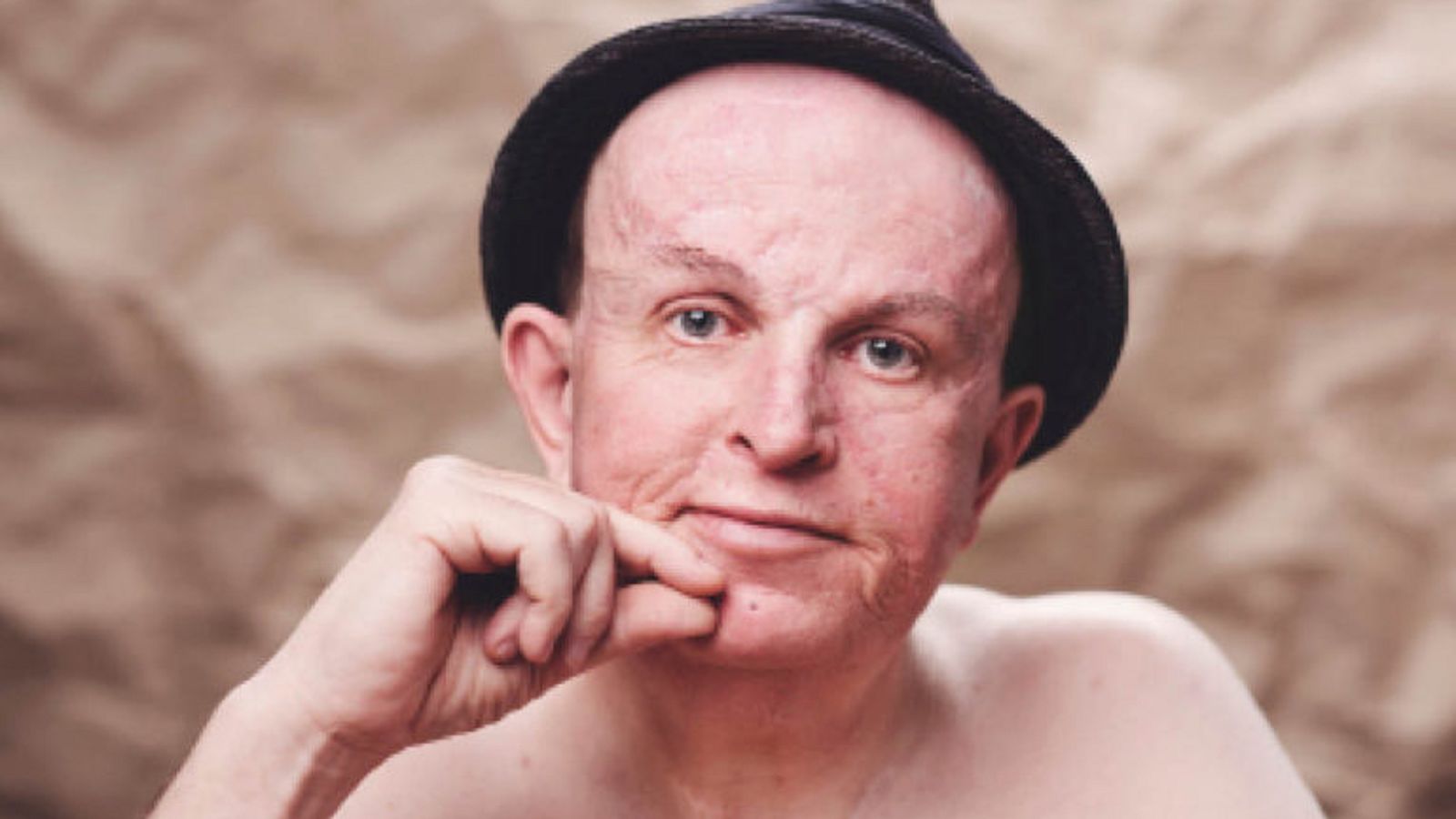 Ervaring met basaalcelnaevus syndroom, Derk-Jan deelt zijn indrukwekkende verhaal