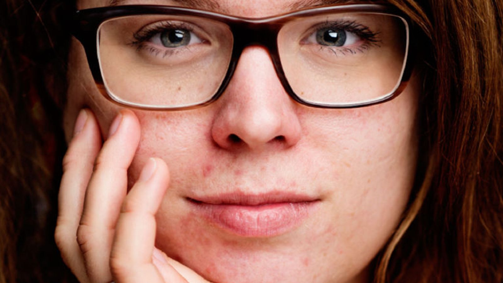 Ervaring met acne - het verhaal van Deirdre