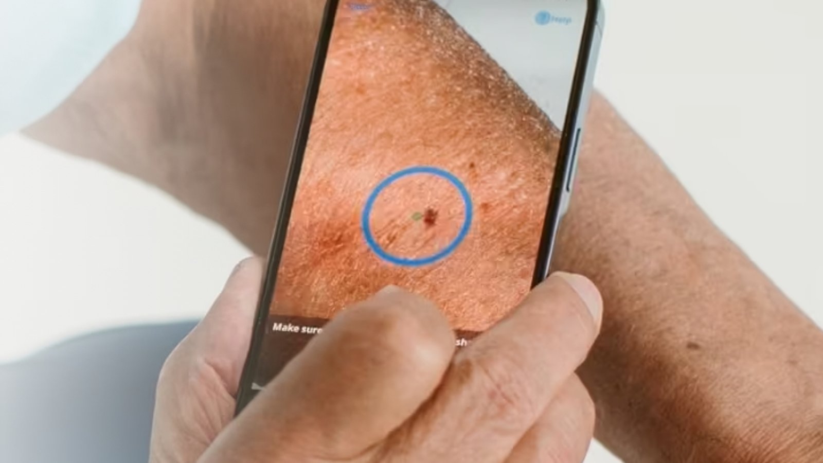 SkinVision ondertekent Zonvenant van Nationaal Huidfonds