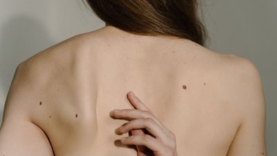Wanneer is een vlekje verdacht? Dermatoloog deelt vijf signalen om na de zomer op te letten
