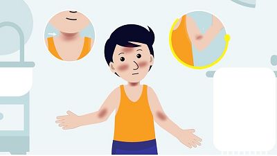 Smeerinstructie pimecrolimus